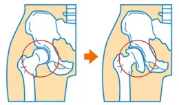 変形性股関節症のイメージ画像
