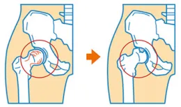 股関節インピンジメント（ＦＡＩ）のイメージ画像