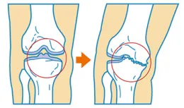 変形性膝関節症のイメージ画像